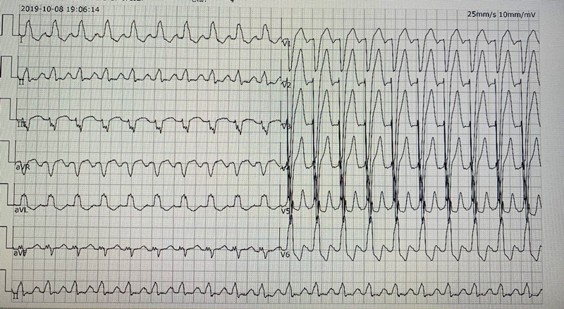 1574739938353028747.png ZRJ术前心电图_副本.png